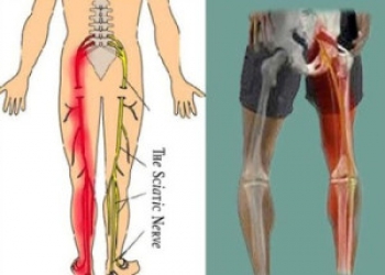 SCIATICA